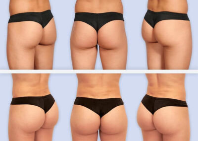 augmenter la taille des fesses, refaire ses fesses