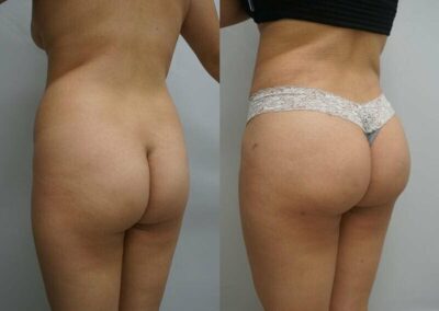 implant fessier tunisie