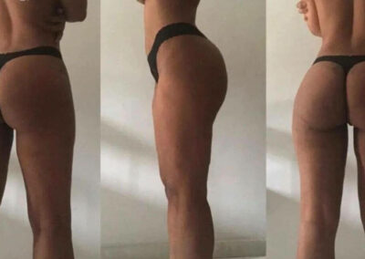 Augmentation des fesses, implant fessier tunisie, chirurgie esthétique tunisie tout compris