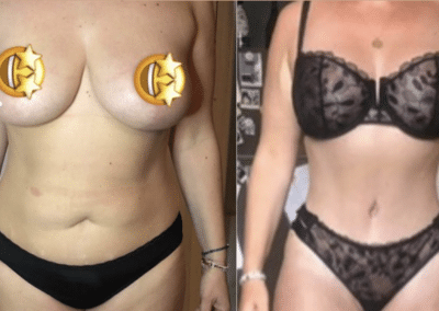 liposuccion tunisie avant après