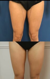 liposuccion cuisse e1677617840125