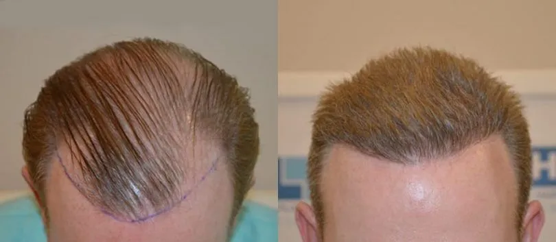 prix greffe de cheveux DHI turnisie greffe de cheveux phi