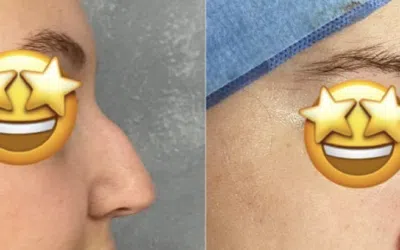 rhino 1 Prévoir le résultat d’une rhinoplastie