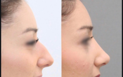 Rhinoplastie clinique