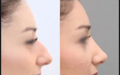 rhino Rhinoplastie clinique