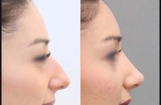 rhinoplastie clinique