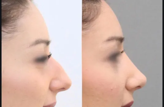 Rhinoplastie clinique