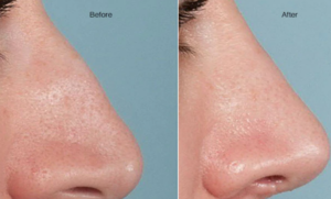 rhinoplastie réussie