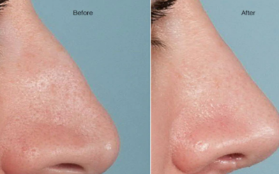 Une rhinoplastie réussie