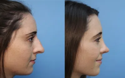 rhinoplastie 8 Objectif 10 ans de moins ils ont choisi la chirurgie esthetique