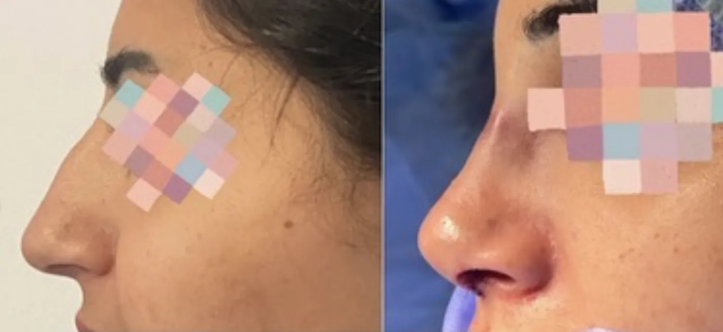 rhinoplastie tunisie estetika Tour