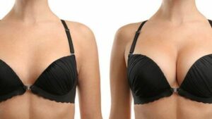 ESTETIKA TOUR chirurgie esthetique tunisie des seins, réduction des seins, Douleurs à la nuque dues à la taille des seins