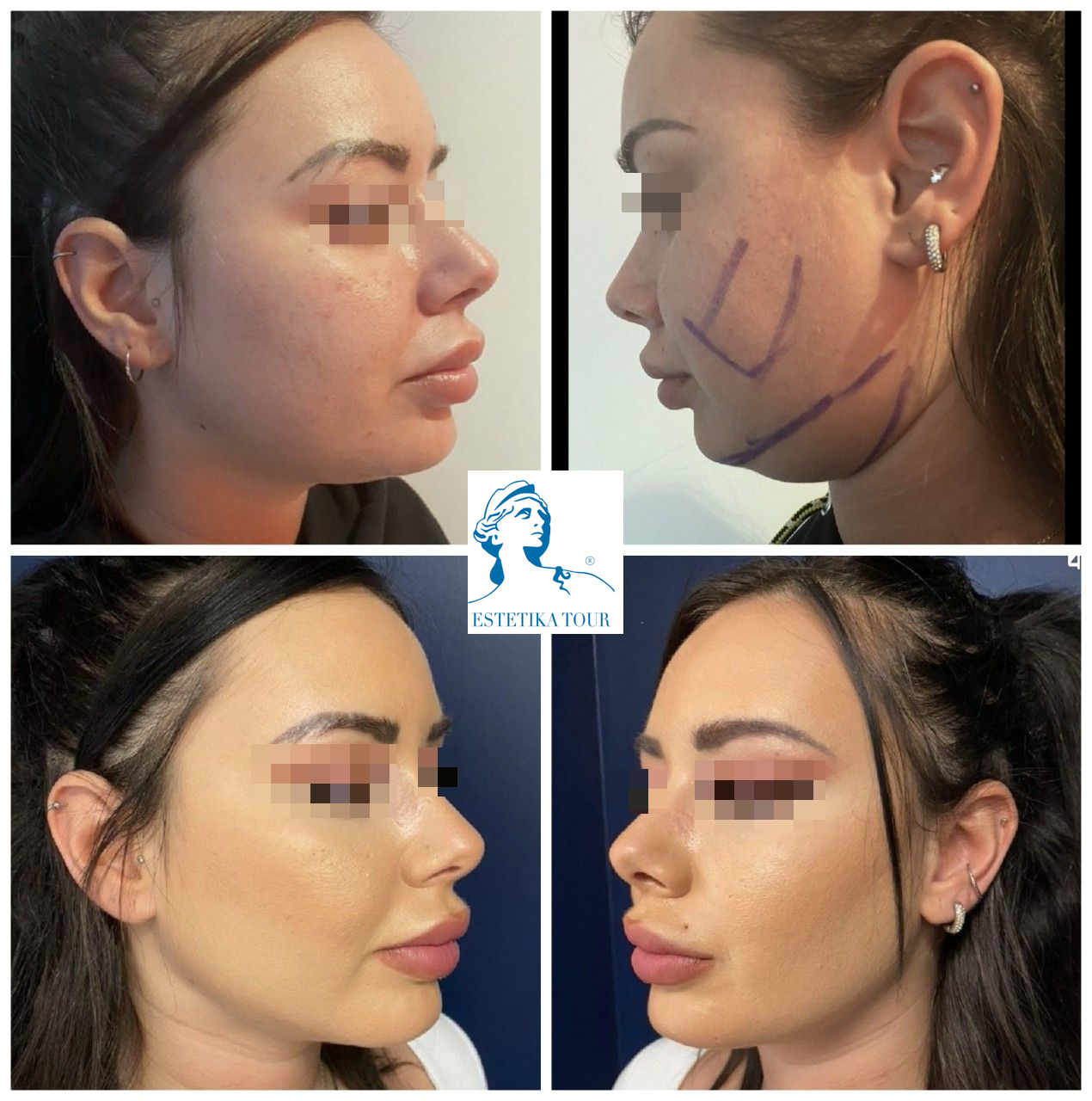Augmentation mammaire tunisie