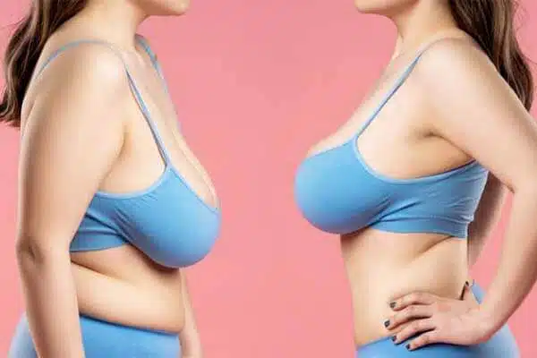 lifting seins tunisie au meilleur prix