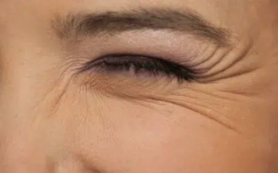 rides sous les yeux comcombre Blépharoplastie en tunisie