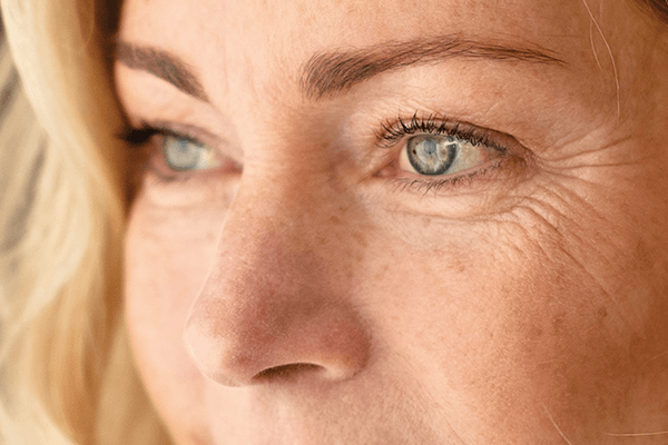 chirurgie esthétique yeux rides, A propos de la blépharoplastie