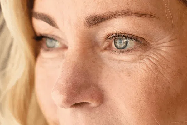 chirurgie esthétique yeux rides, A propos de la blépharoplastie