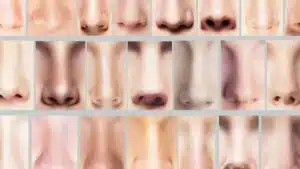 rhinoplastie estetika tour, nez parfait