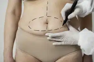 Chirurgie esthétique réparatrice du ventre