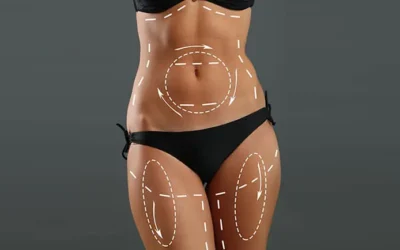 Où faire une liposuccion en Tunisie ?