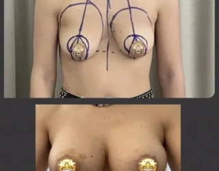 Lifting des seins avec prothèses