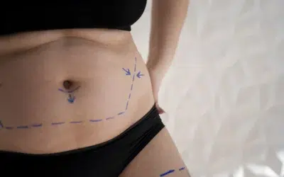 Quel est le prix d’une liposuccion au ventre ?
