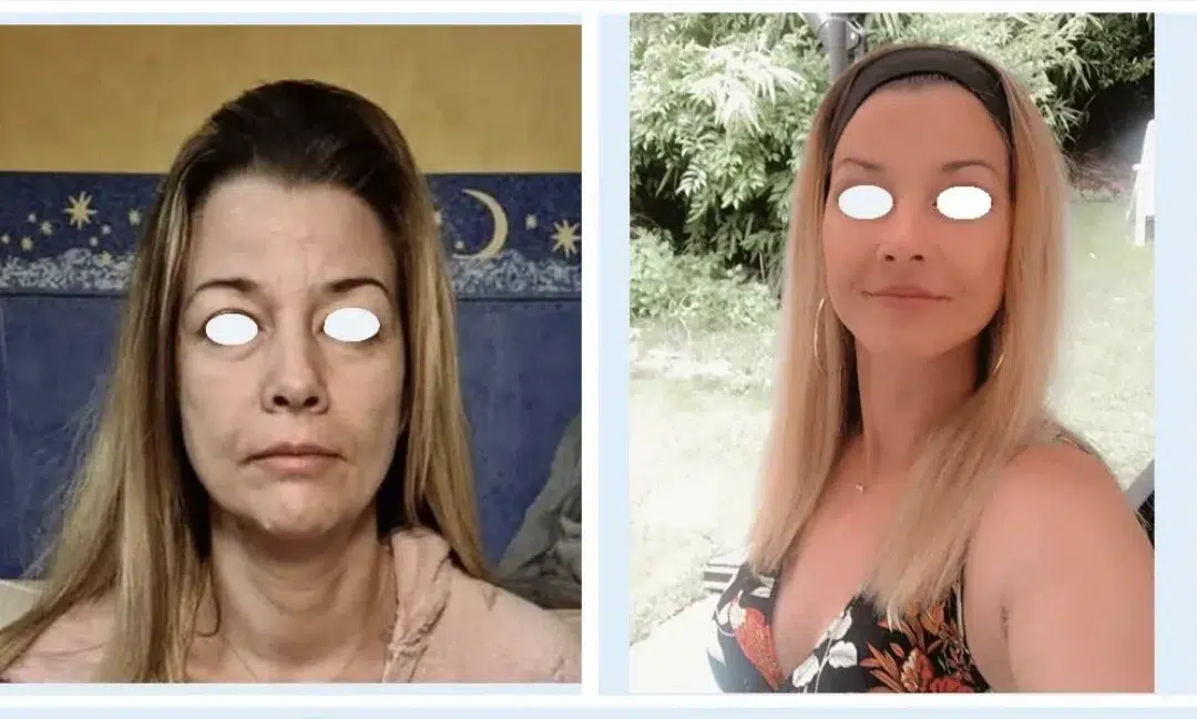 Lifting cervico facial tunisie, Lifting N°1, Lifting du visage en Tunisie, Chirurgie esthétique tunisie Avant / Après