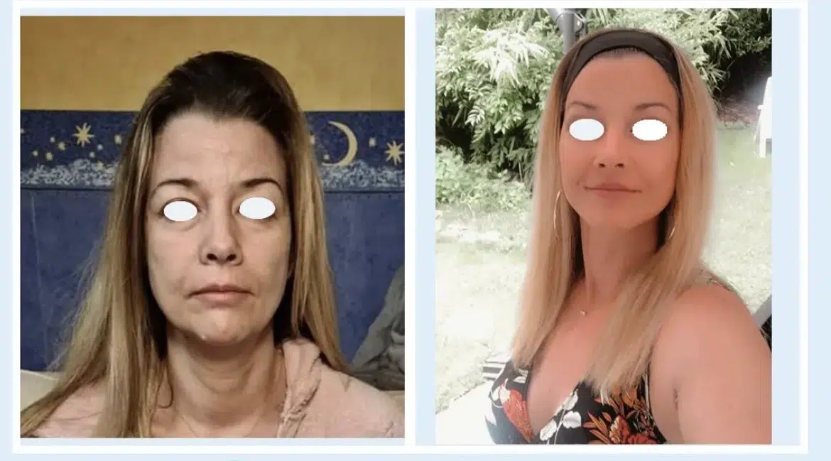 Lifting cervico facial tunisie, Lifting N°1, Lifting du visage en Tunisie, Chirurgie esthétique tunisie Avant / Après