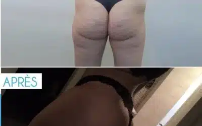 Augmentation des fesses en Tunisie tout compris