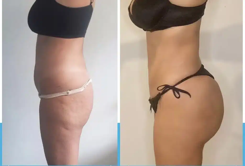 Augmentation des fesses tunisie
