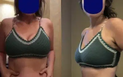 abdominoplastie tunisie prix