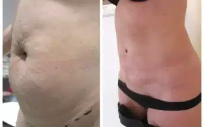 abdominoplastie tunisie prix estetika Prix abdominoplastie tunisie