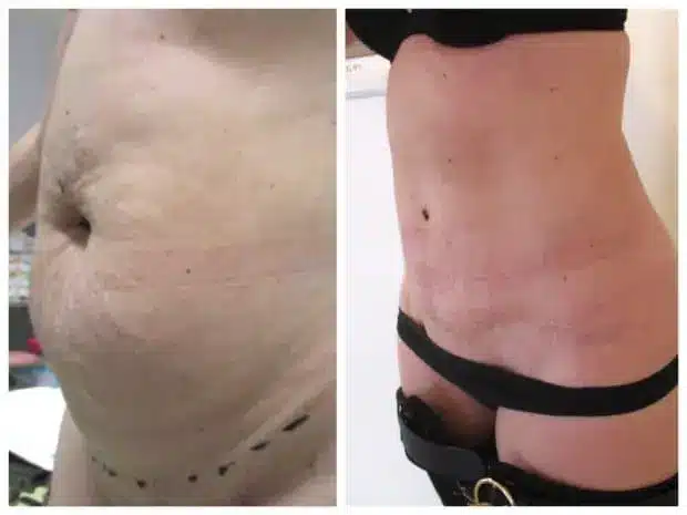 Quel type d'abdominoplastie choisir, Principales indications de l'abdominoplastie