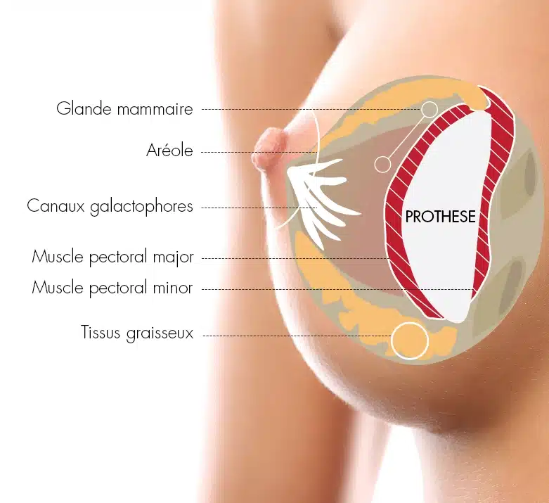 changement de prothèse mammaire tunisie