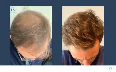 Prix des greffes de cheveux