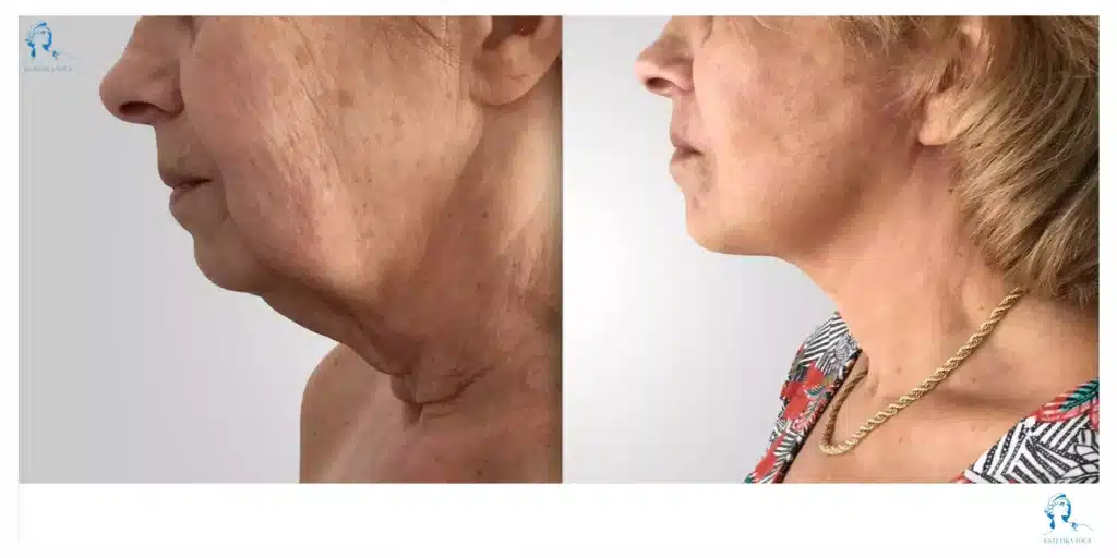 lifting du visage en tunisie estettika lifting du visage en tunisie estetika, Lifting visage prix