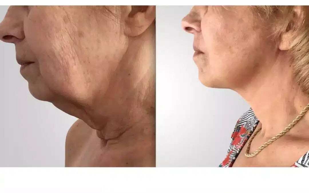 Lifting visage prix