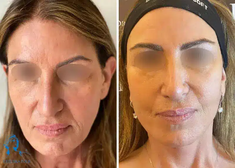Lifting frontal prix
