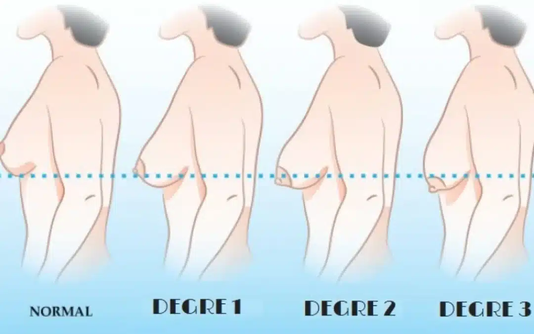 lifting mammaire ou augmentation mammaire comment choisir ?