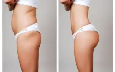 liposuccion ventre prix 1 Gros ventre femme: Causes et solutions