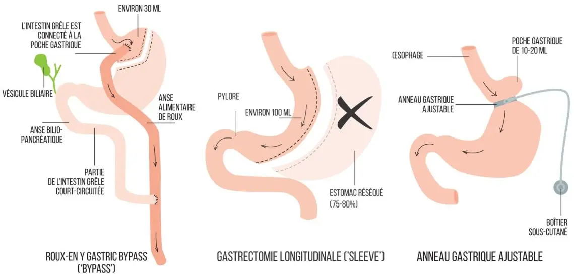 bypass, sleeve prix, anneau gastrique tunisie