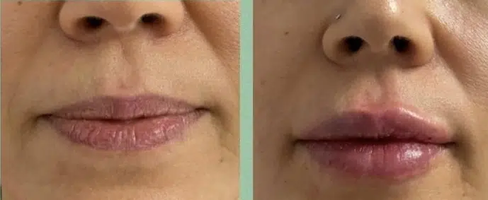 Augmentation des lèvres avant après