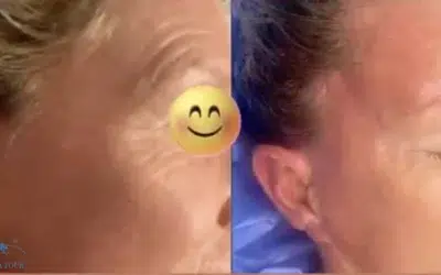 Blepharoplastie La Blépharoplastie