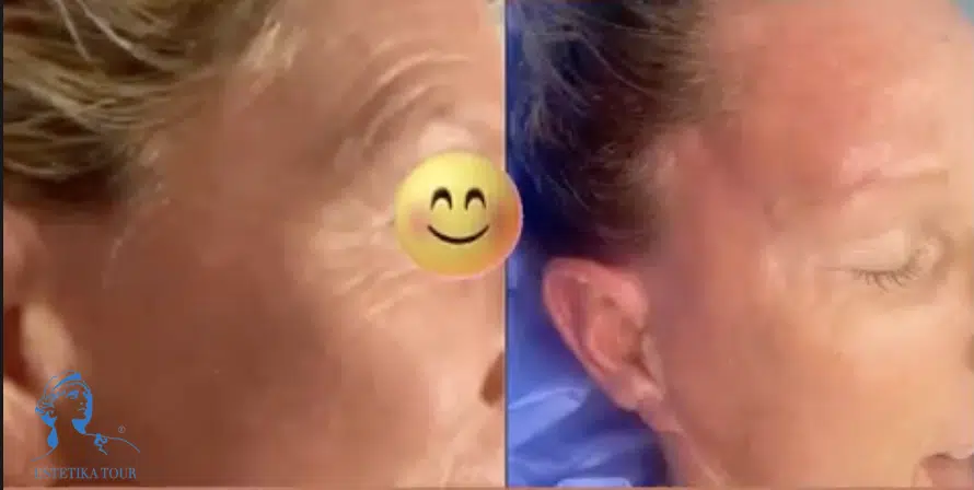 La Blépharoplastie
