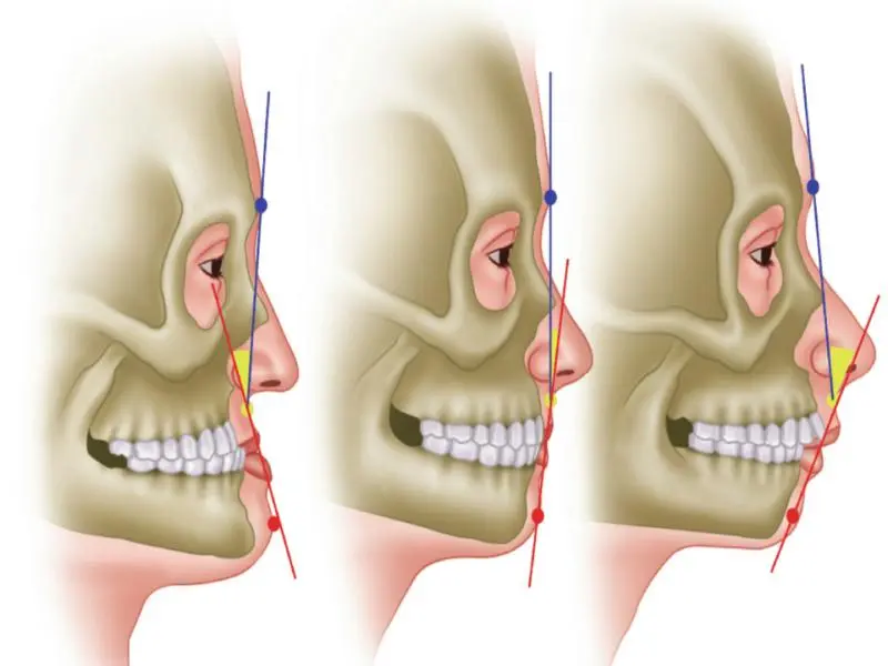 Chirurgie maxillo facial