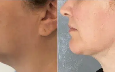 Lipo double menton Chirurgie double menton prix tunisie