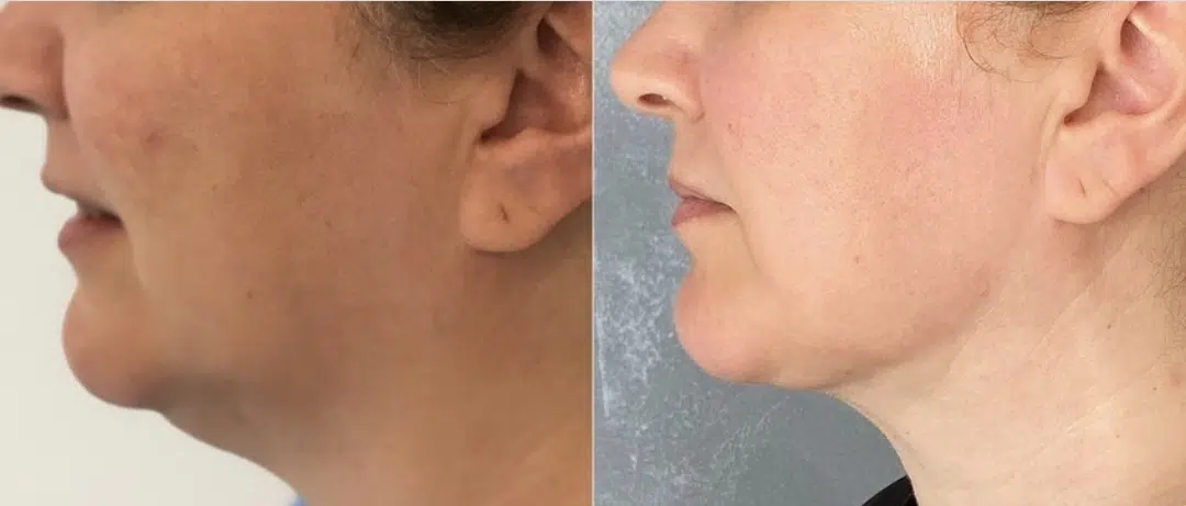 Chirurgie double menton prix tunisie