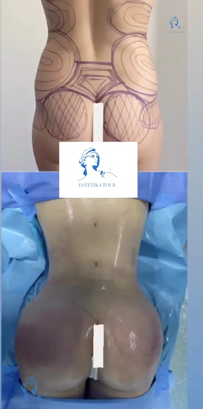 Lifting colombien, Augmentation fesses et labiaplastie