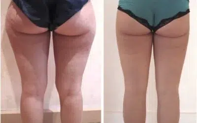 Liposuccion culotte de cheval cuisse Perdre des cuisses avant apres
