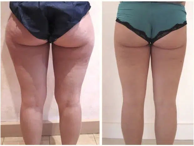 Perdre des cuisses avant apres